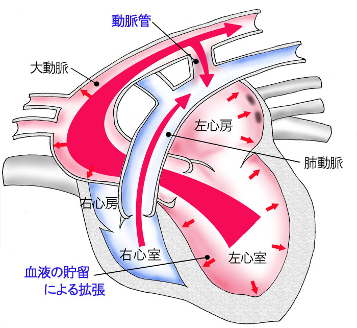動脈管の開存
