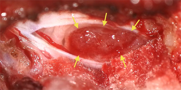 硬膜内の腫瘍